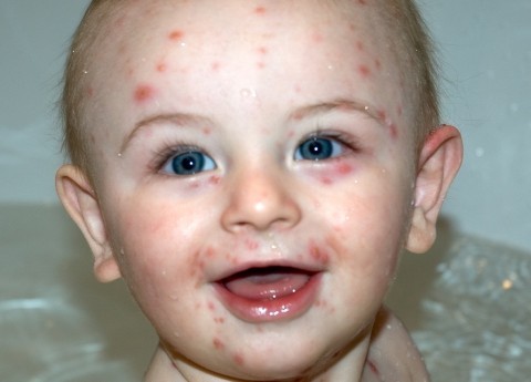 Smallpox in an infant &#8211; symptoms, treatment