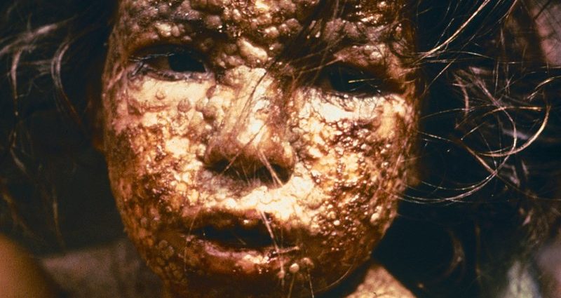 Smallpox in children &#8211; symptoms, treatment and course of the disease. How long does smallpox last?