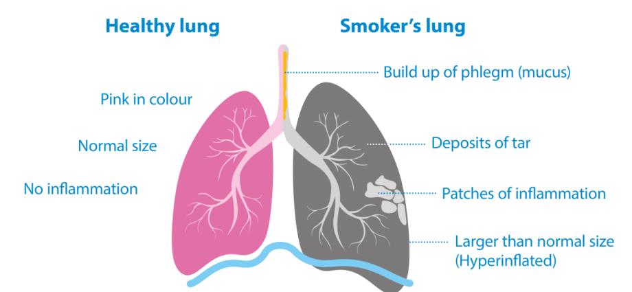 Smoking damages the lungs. No matter how much you smoke