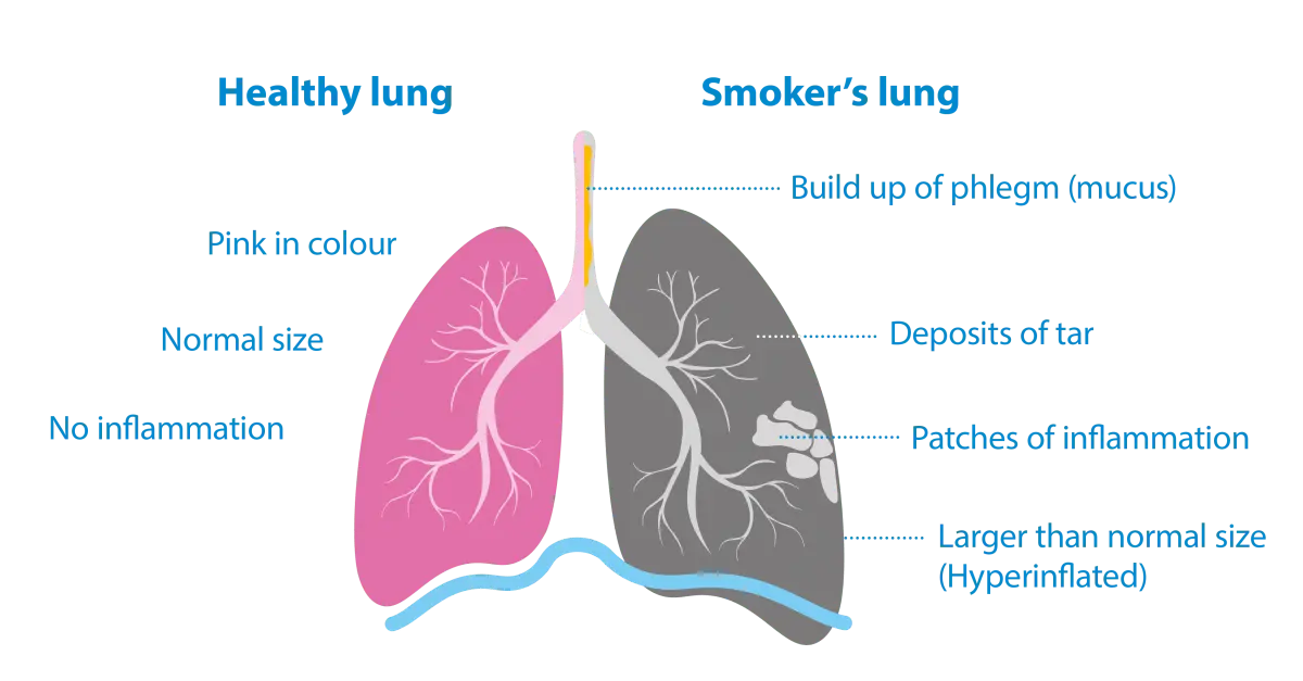 Smoking damages the lungs. No matter how much you smoke