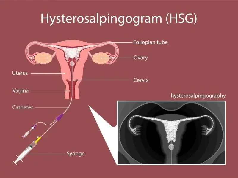 SONO HSG in the diagnosis of female infertility &#8211; preparation for the examination, course, results and possible complications