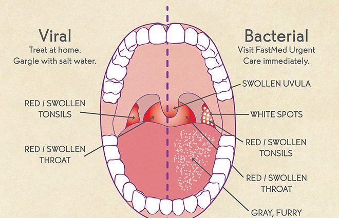 Sore throat &#8211; viral and bacterial infections