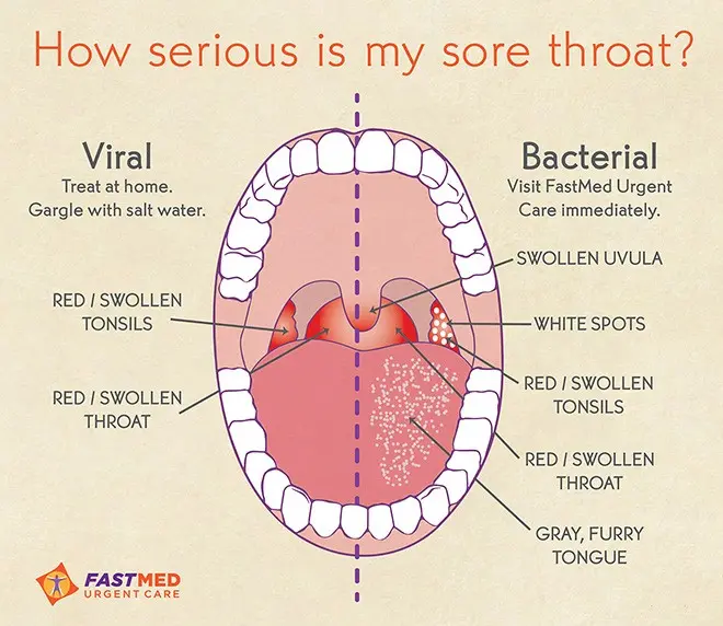 Sore throat &#8211; viral and bacterial infections