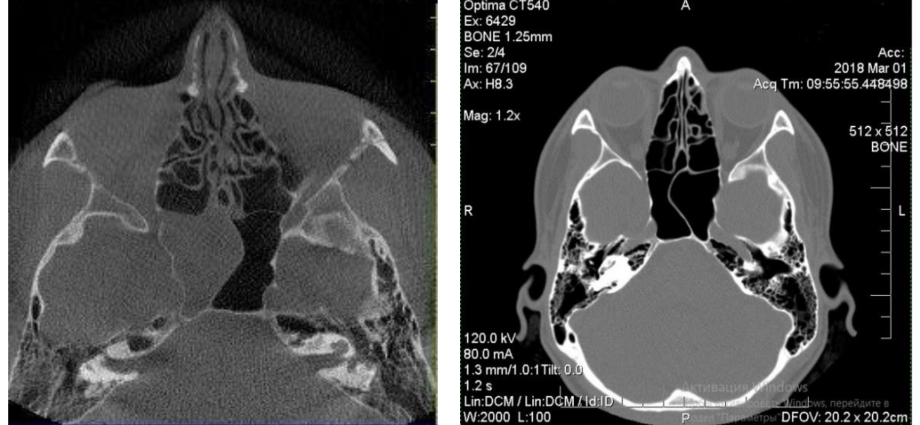 Sphenoiditis &#8211; Is Surgery Necessary?