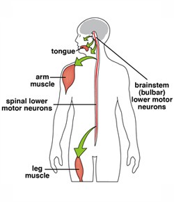 Spinal bulbar muscle atrophy