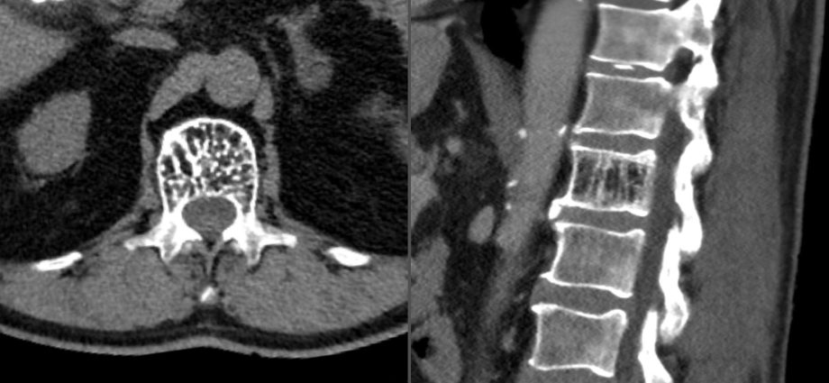 Spinal hemangioma &#8211; what is it, types, causes, treatment