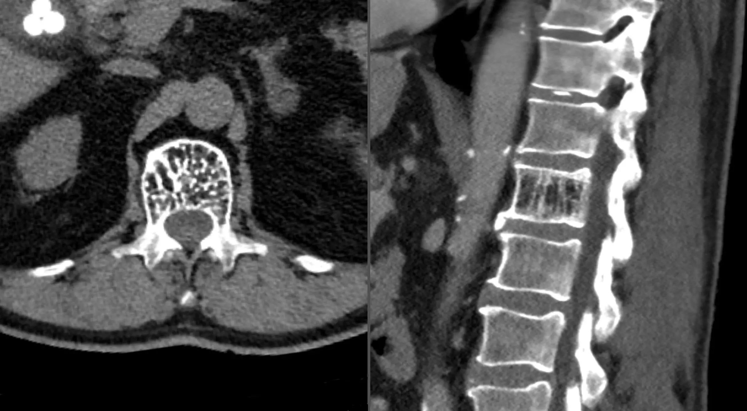 Spinal hemangioma &#8211; what is it, types, causes, treatment