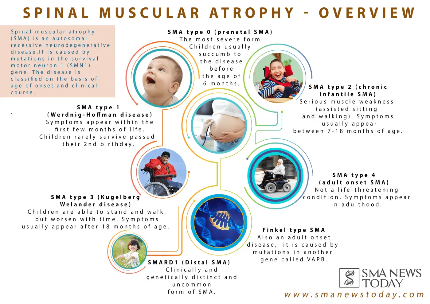 Spinal Muscular Atrophy (SMA) &#8211; diagnosis, clinical forms