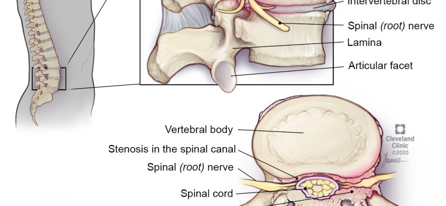 Spinal stenosis &#8211; causes and symptoms. How to treat spinal stenosis?