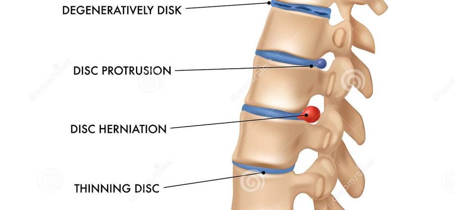 Spine &#8211; structure, diseases