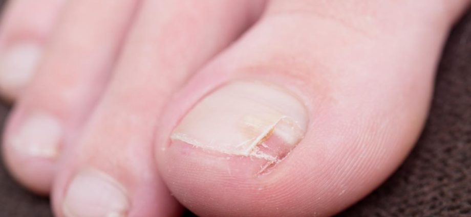 Split nails – the most common causes, diseases, treatment – Healthy ...