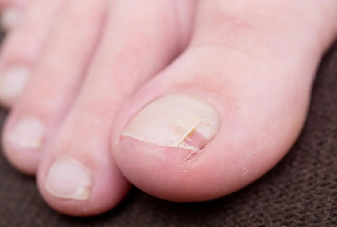 Split nails &#8211; the most common causes, diseases, treatment