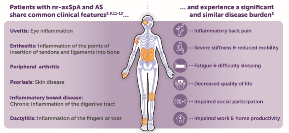 Spondyloarthritis &#8211; Symptoms, Causes and Treatment