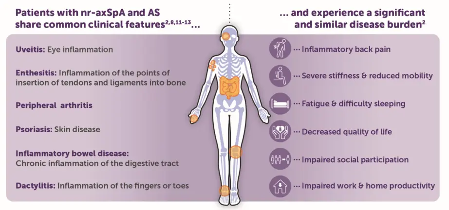 Spondyloarthritis &#8211; Symptoms, Causes and Treatment