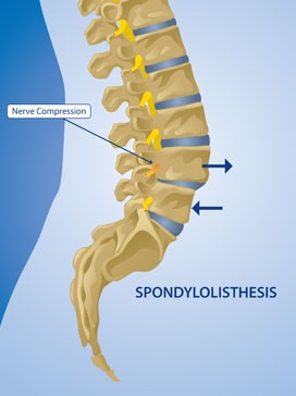 Spondylolisthesis &#8211; how does it arise? Treatment for the dislocation of the vertebrae