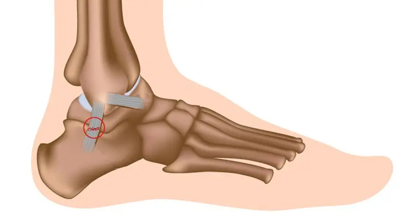 Sprained ankle &#8211; symptoms, complications, rehabilitation