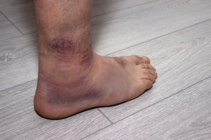 Sprained ankle &#8211; what does it look like? Compensation for a sprained ankle