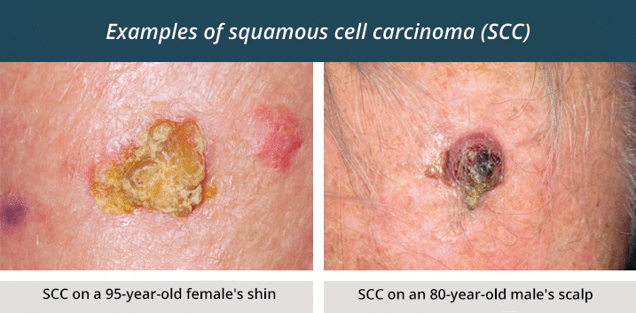 Squamous cell carcinoma &#8211; characteristics and types of the disease