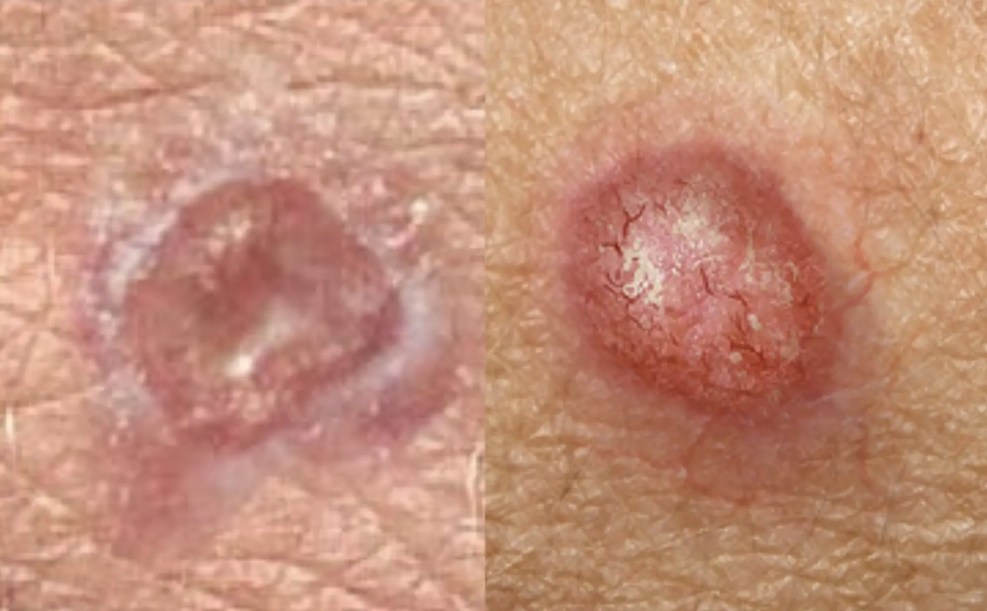 Squamous cell carcinoma looks harmless at first. It attacks people with light skin