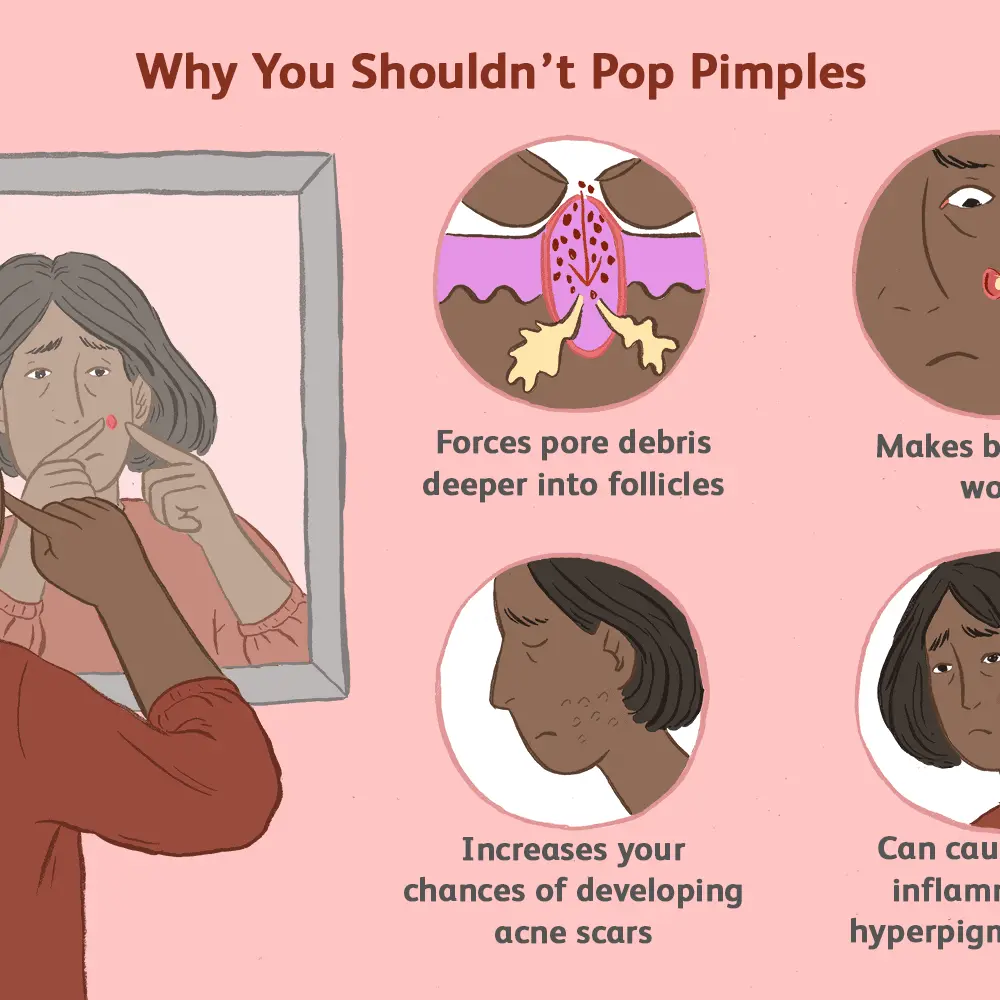 Squeezing pimples &#8211; addiction or disease? Causes and consequences of squeezing pimples [WE EXPLAIN]