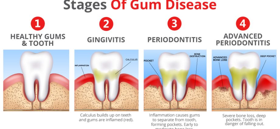 Stages of gum disease &#8211; tartar, periodontitis, moving gums