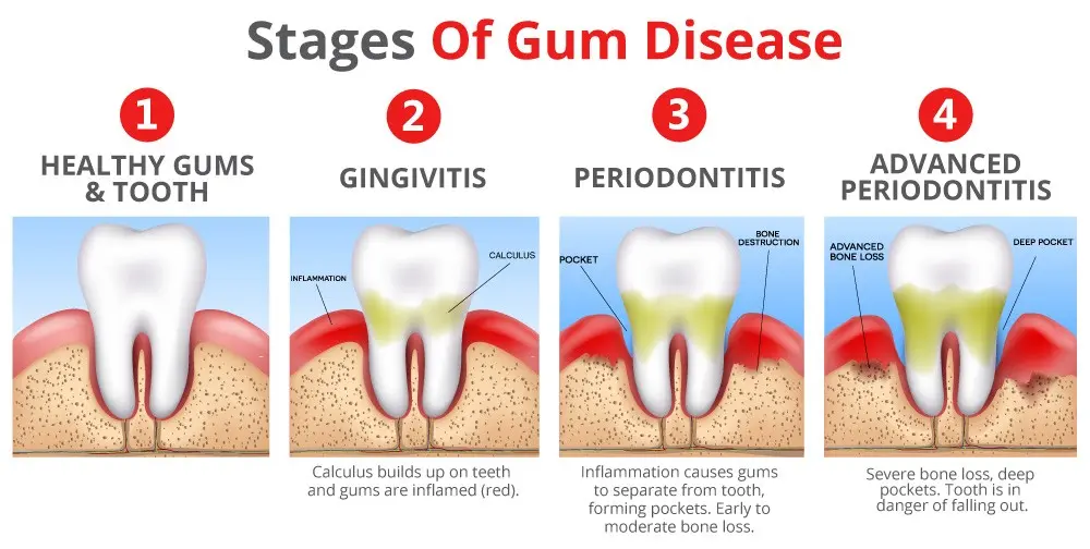 6-gum-disease-symptoms-you-shouldn-t-ignore