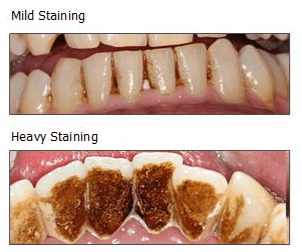 Stains on teeth &#8211; where do they come from and how to prevent them?