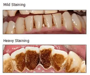 Stains on teeth &#8211; where do they come from and how to prevent them?