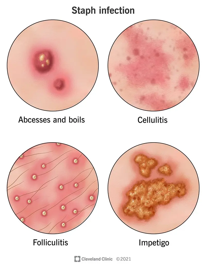 Staphylococcal infection