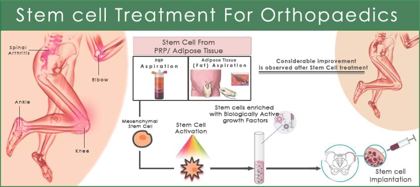 Stem cells in orthopedics &#8211; how are they used?