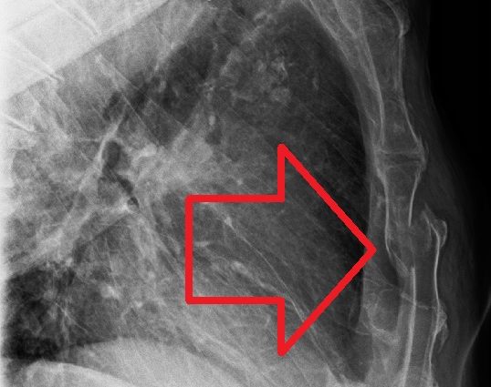 Sternum fracture &#8211; diagnosis, treatment