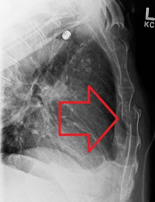 Sternum fracture &#8211; diagnosis, treatment