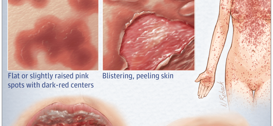 Stevens-Johnson syndrome &#8211; causes, symptoms, treatment of erythema multiforme