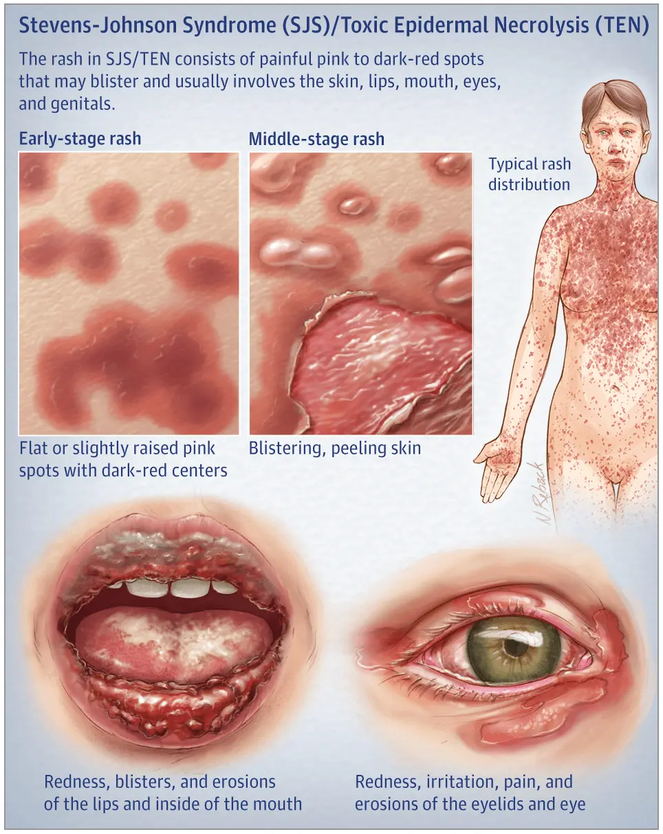 Stevens-Johnson syndrome &#8211; causes, symptoms, treatment of erythema multiforme