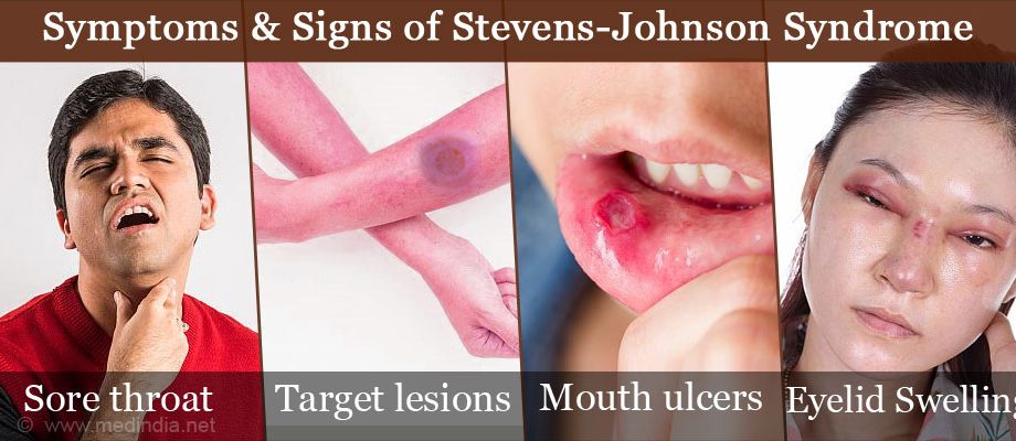 Stevens-Johnson Syndrome: Symptoms, Causes, and Treatment