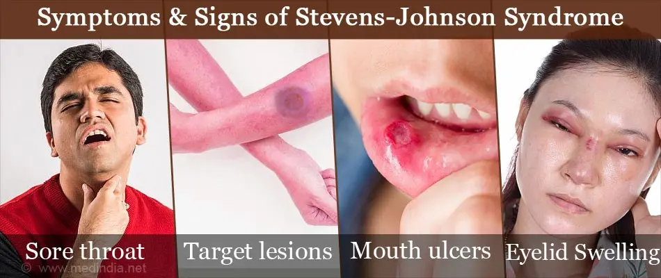 Stevens-Johnson Syndrome: Symptoms, Causes, and Treatment