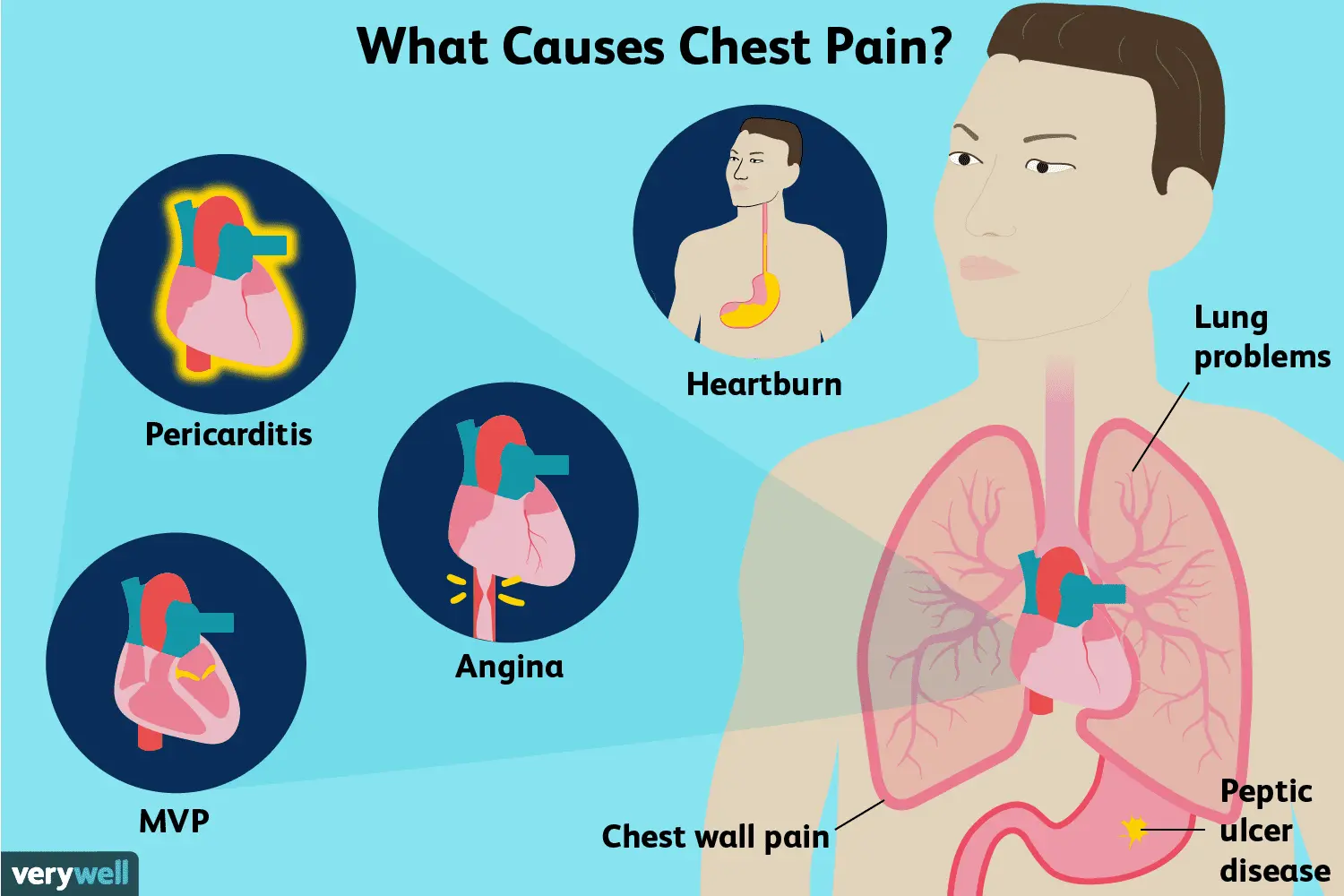 Stings in the chest &#8211; causes, types, diagnosis. When to see a doctor?