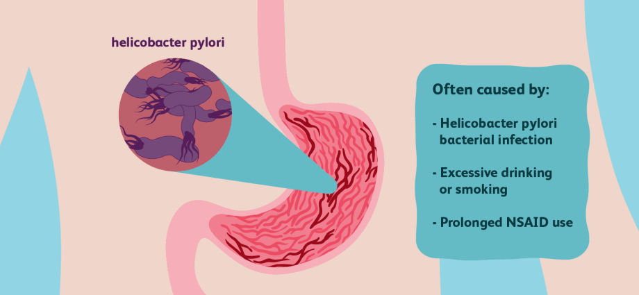 Stomach erosions &#8211; symptoms, diagnosis