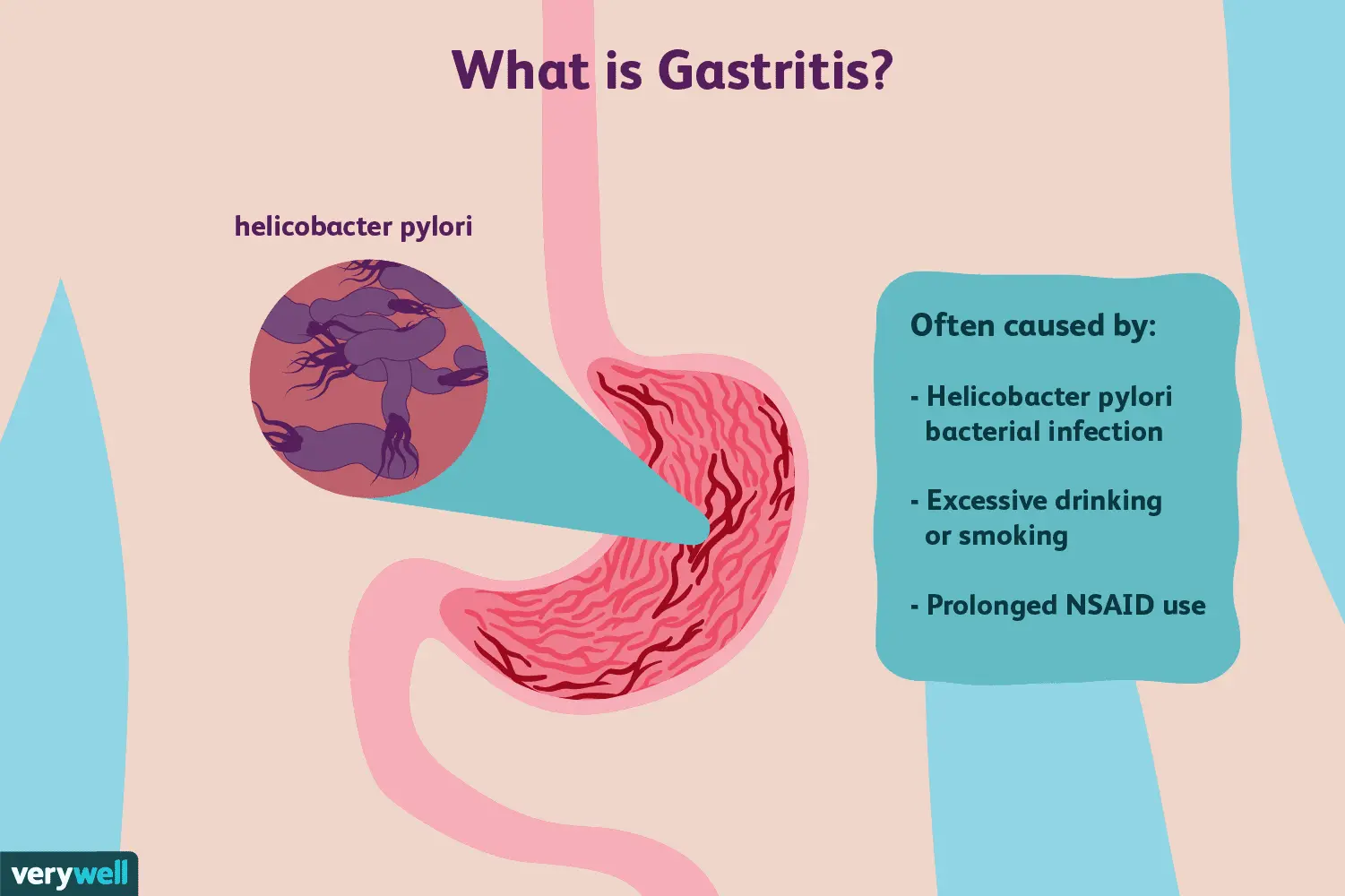 Stomach erosions &#8211; symptoms, diagnosis