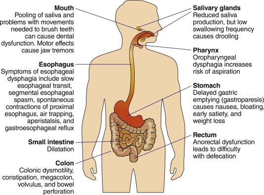 Stomach ulcers and Parkinson&#8217;s disease may have a common cause