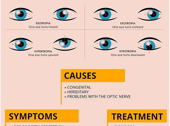 Strabismus &#8211; causes, types, diagnostics. Can strabismus be treated?