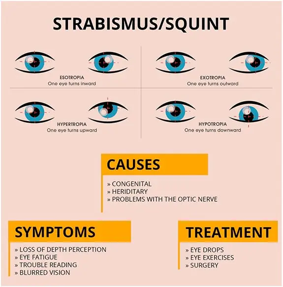 Strabismus &#8211; causes, types, diagnostics. Can strabismus be treated?