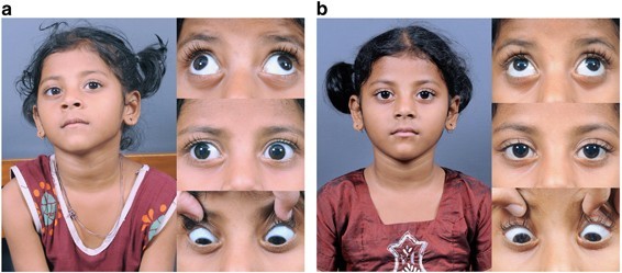 Strabismus correction in children &#8211; what are the effects?