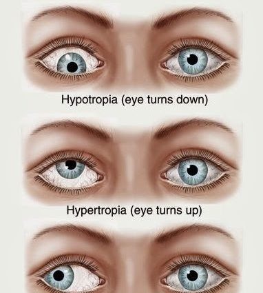 Strabismus in a child &#8211; types, symptoms, diagnosis, treatment. The effectiveness of strabismus surgery