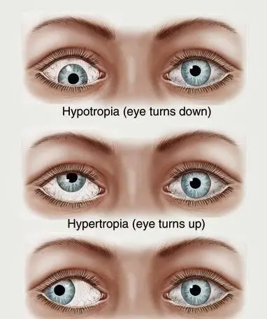 Strabismus in a child &#8211; types, symptoms, diagnosis, treatment. The effectiveness of strabismus surgery