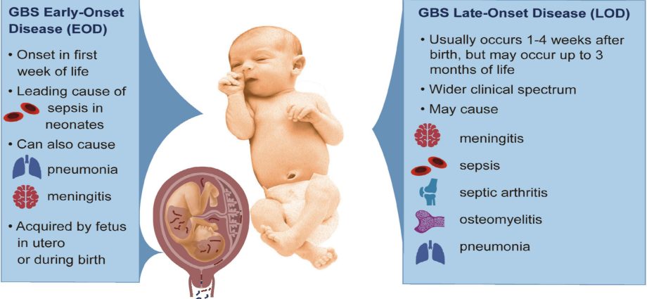 Streptococcus agalactiae &#8211; group B streptococcus (GBS) &#8211; a threat to the newborn