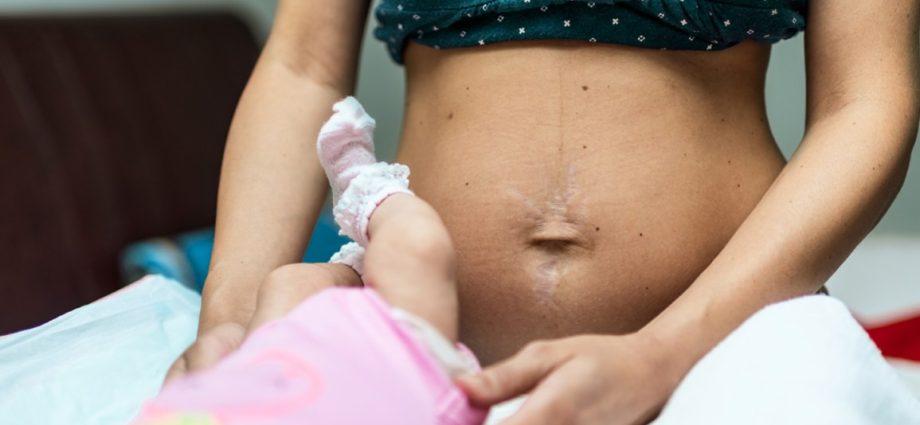 Stretch marks in pregnancy &#8211; is it possible to get rid of them?