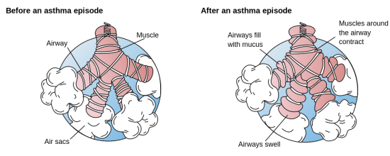 Stridor &#8211; how to recognize wheezing?