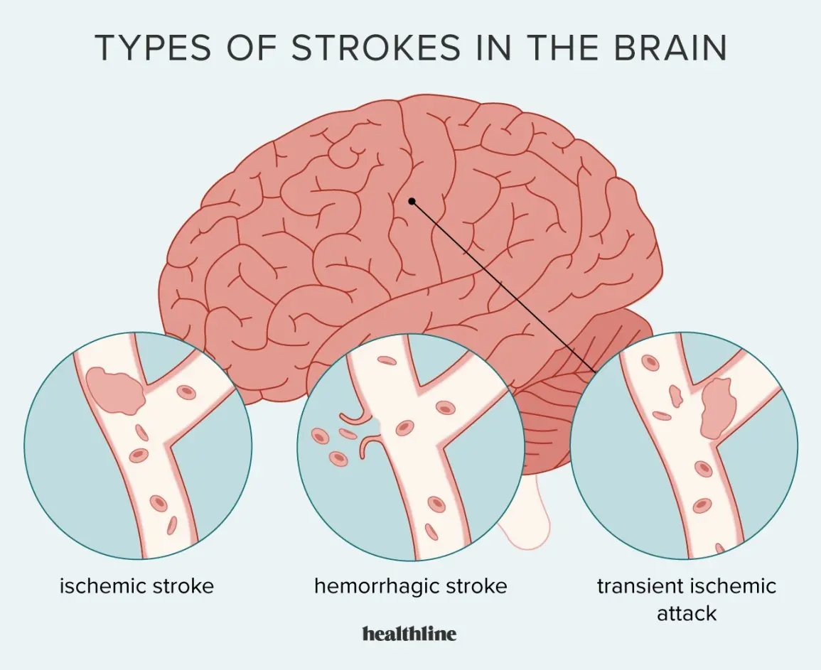 Stroke &#8211; causes, symptoms, treatment [WE EXPLAIN]