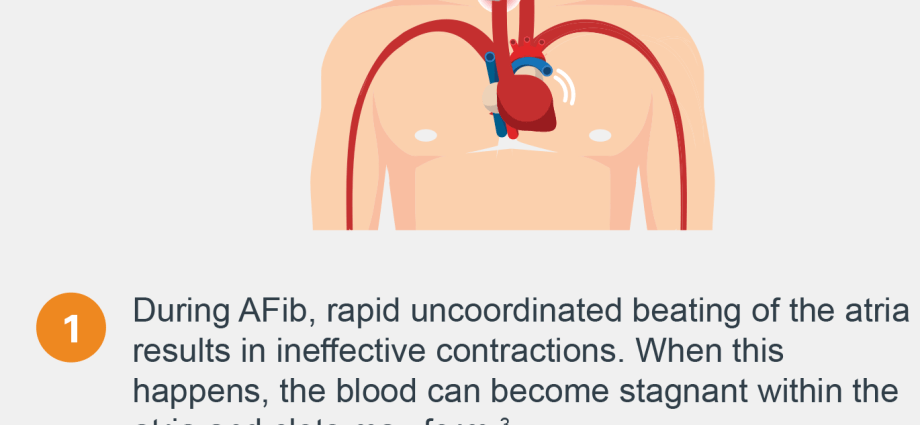 Stroke &#8211; the greatest enemy of patients with atrial fibrillation